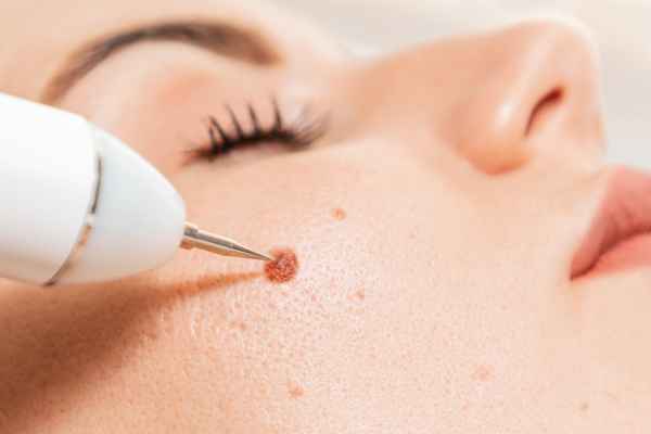 CryoPen: 5 Skin Concerns It May Be Used to Treat 3 What actually happens during a CryoPen treatment Nottingham?